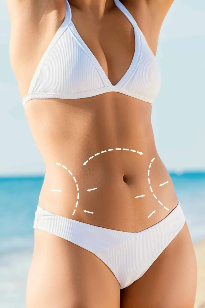 Liposuction Recovery Tips: Smooth and Quick Healing Process