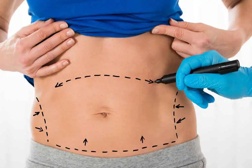Liposuction Scars: Understanding and Minimizing Their Visibility