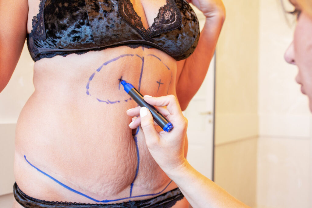 After Giving Birth – Tummy Tuck in Turkey